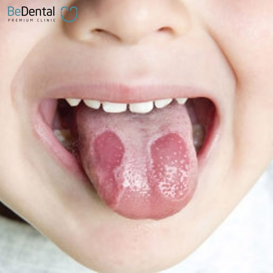 Tongue inflammation and 7 common tongue diseases.