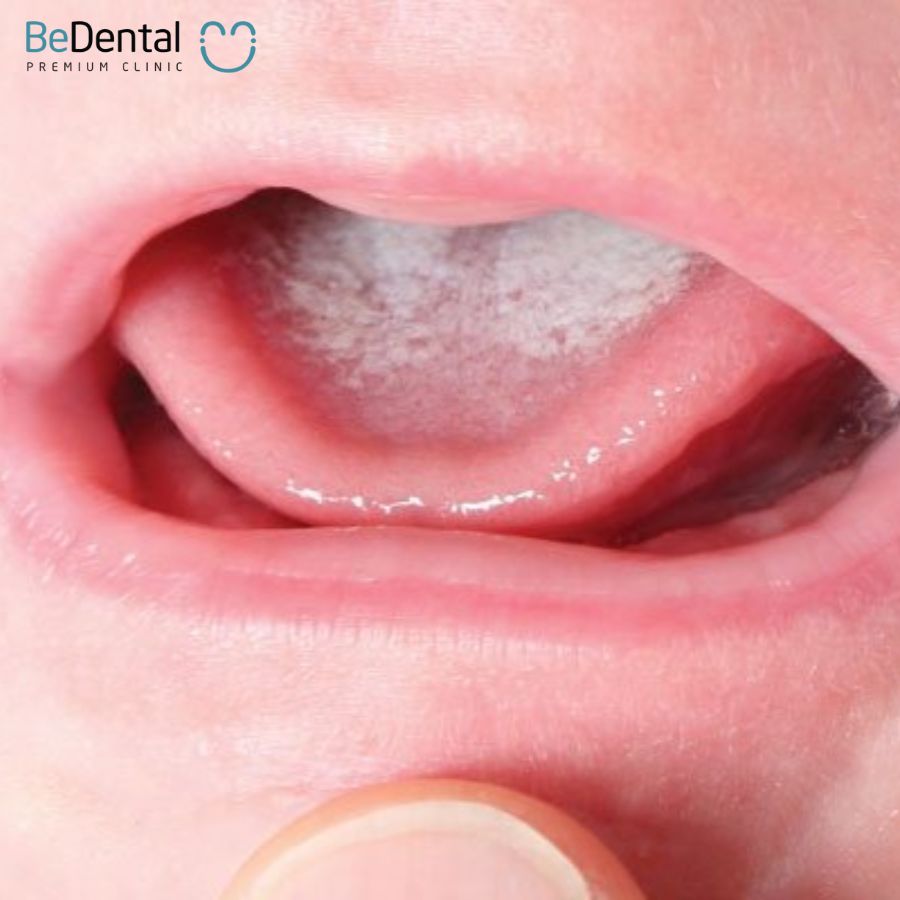 Tongue inflammation and 7 common tongue diseases.