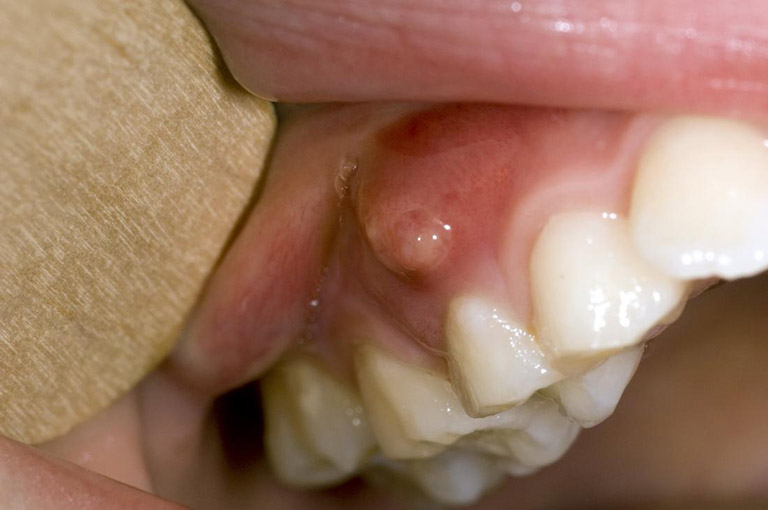 Bệnh lý áp xe răng