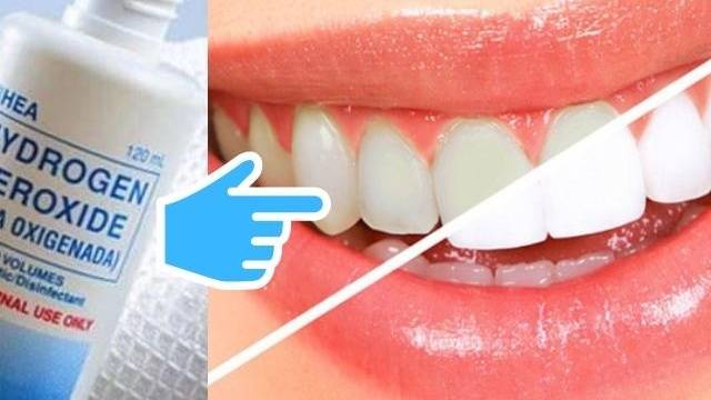 Cách làm trắng răng sau 1 đêm bằng oxy già