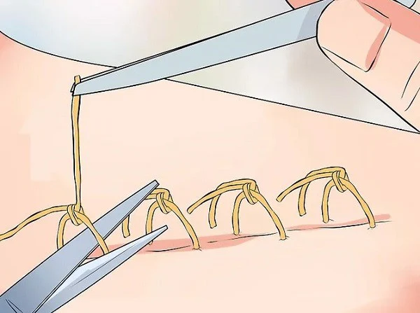 How to clean a wound with dissolvable stitches