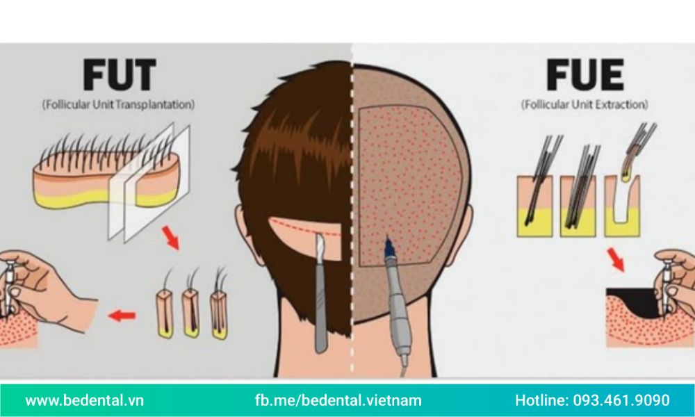 Hai phương pháp cấy tóc