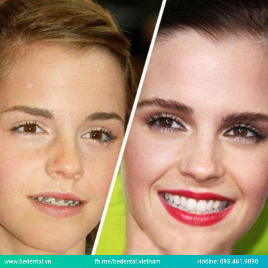 Emma Watson thời điểm niềng răng khắc phục hàm răng xấu.