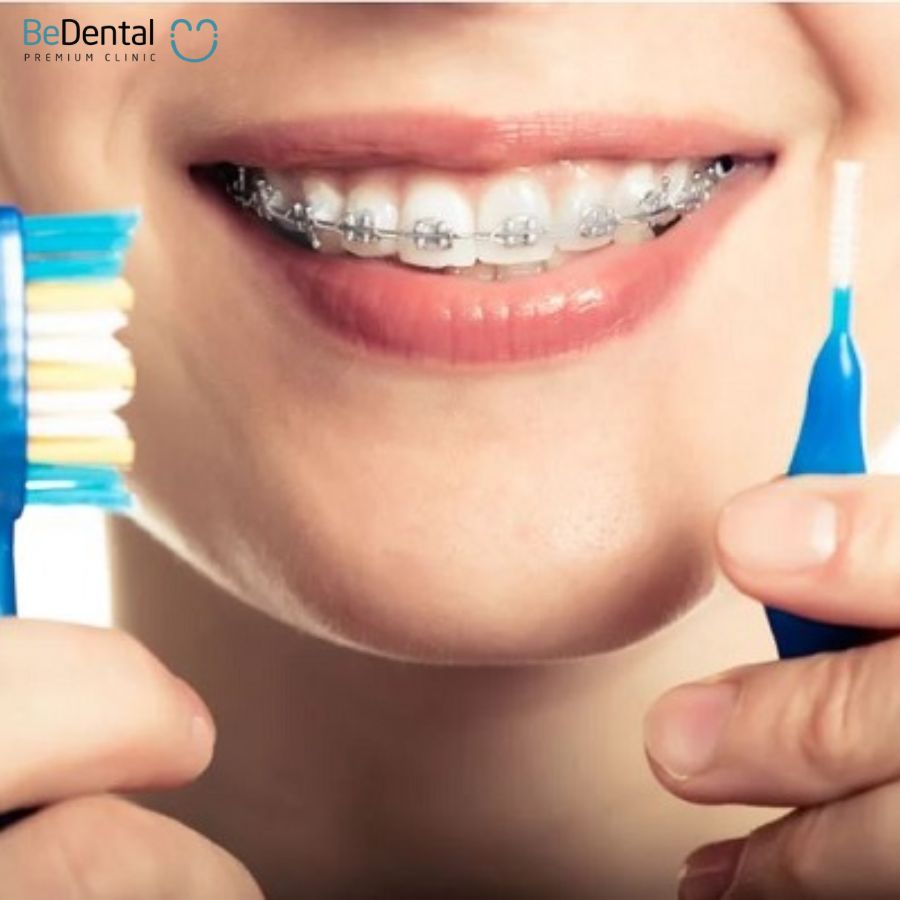 Đánh răng đúng cách đảm bảo quá quá trình niềng răng thuận lợi