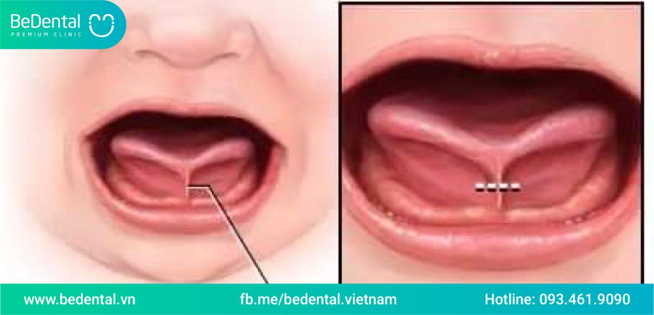 Dính phanh lưỡi