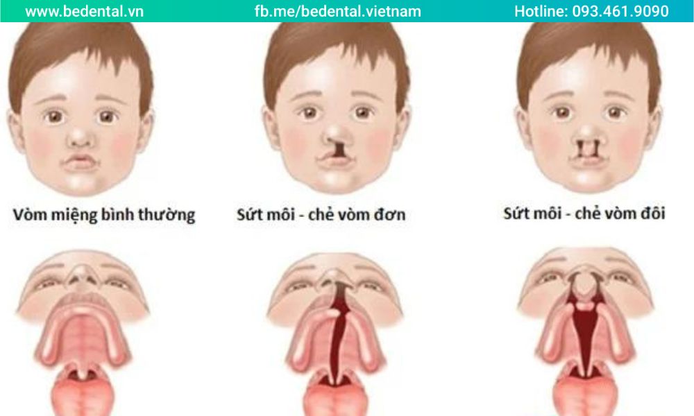 Các biểu hiện của bệnh sứt môi hở hàm ếch ở trẻ