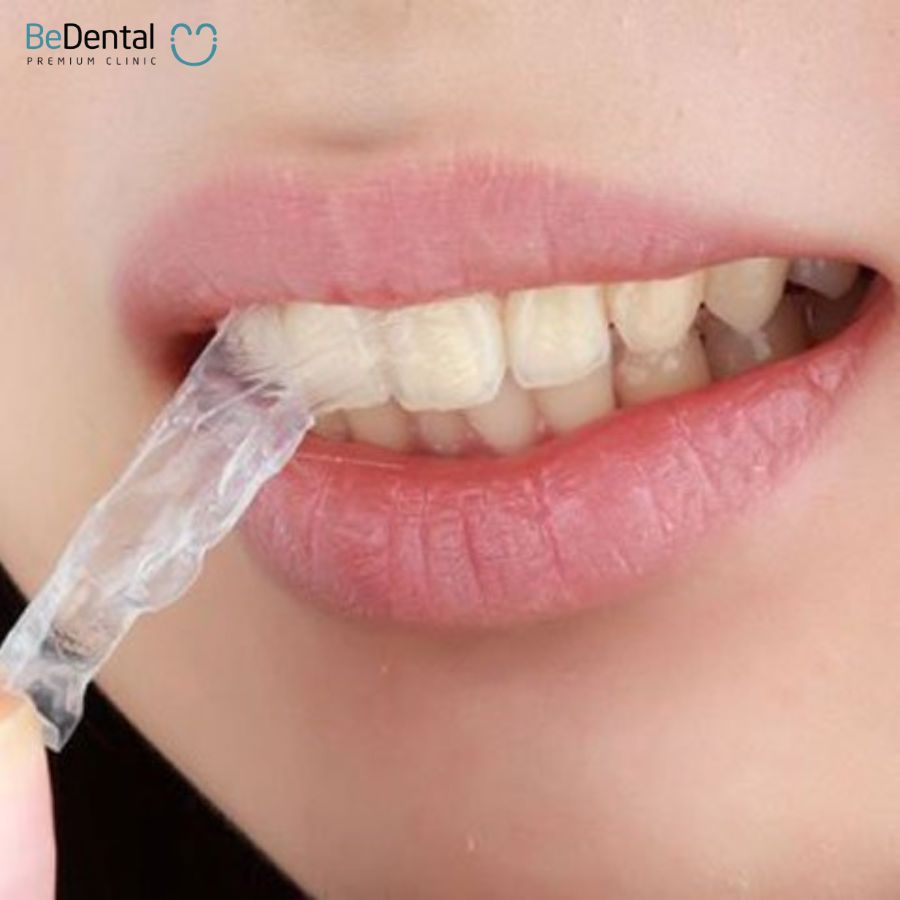 Tác hại của miếng dán trắng răng có thể ảnh hưởng tới ngà răng nếu dùng không đúng cách