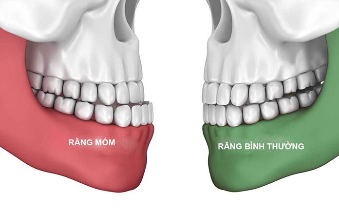 Phân biệt móm răng và móm hàm dưới