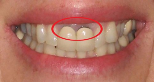 Hiện tượng đen viền nướu sau khi dùng răng sứ Titan được khoảng thời gian