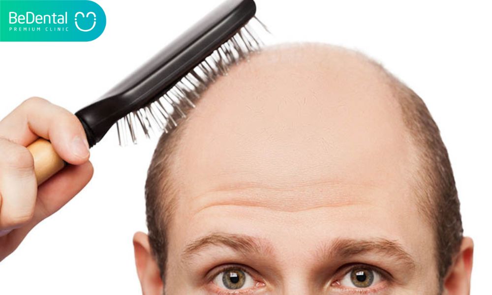 Người có người thân trong gia đình có người bị hói đầu có nguy cơ rụng tóc cao hơn bình thường