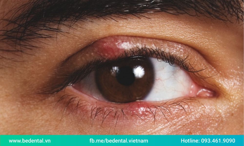 Lẹo mắt có thể lây lan và thường tái phát