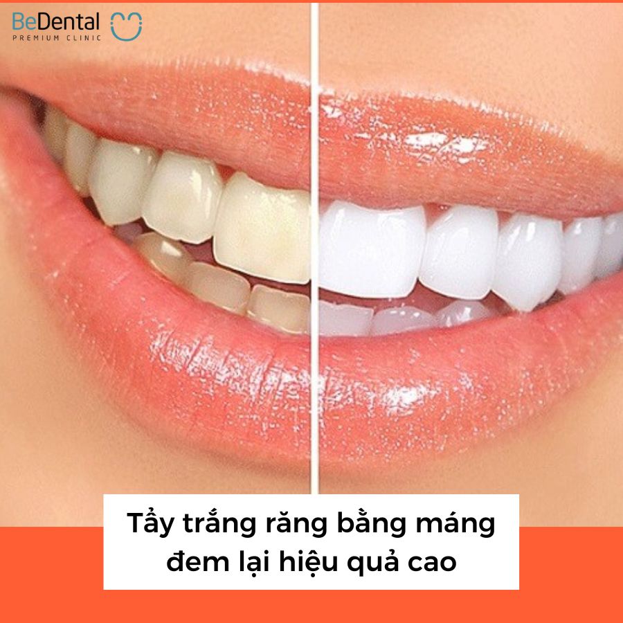 Tẩy trắng răng bằng máng đơn giản và đem lại hiệu quả cao