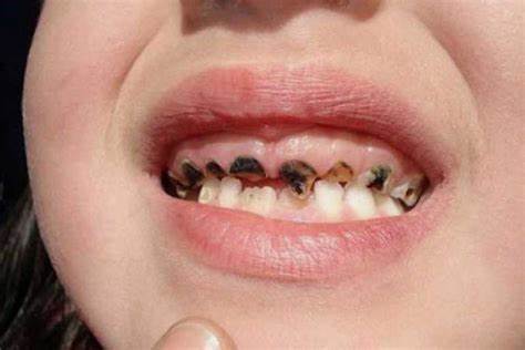 Trẻ bị sún răng có thể mất răng cửa hoàn toàn.