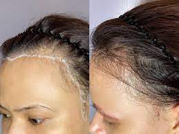 Cấy tóc để xử lý phần trán dô