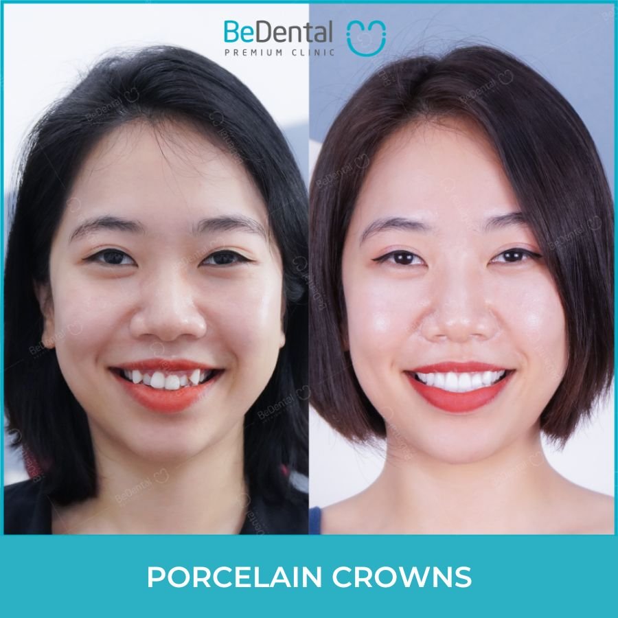 Dental crowns - Be Dental