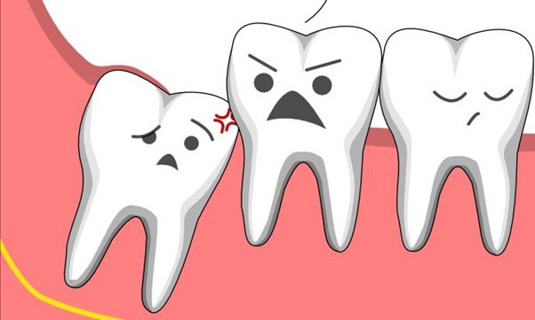 Răng khôn mọc lệch có thể làm ảnh hưởng đến răng kế cạnh 
