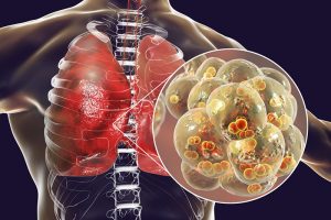 Người bệnh viêm phổi nặng do virus Corona tấn công