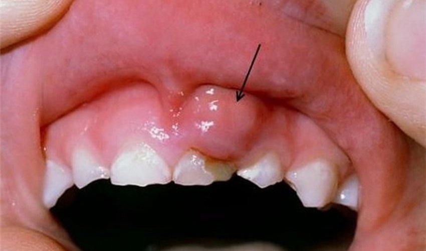 Xuất hiện khối u nướu răng
