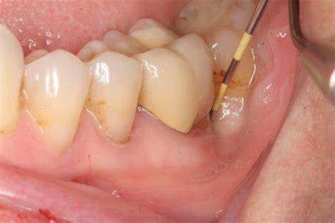 Hơi thở nặng mùi là biểu hiện của sâu răng khi niềng răng