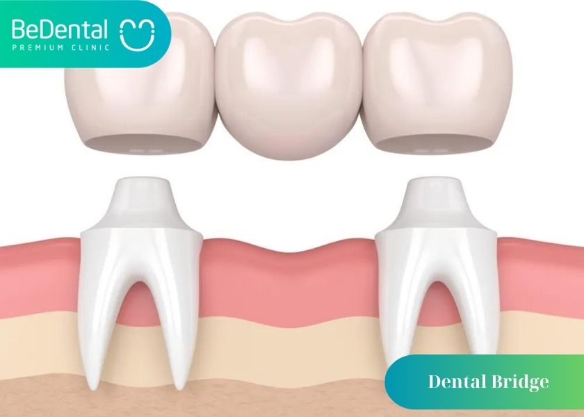 Dental Bridge's Procedure