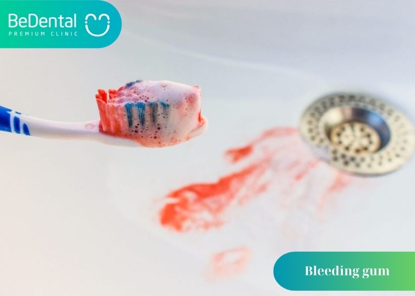 Are bleeding gums serious?