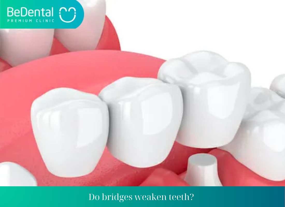 Do bridges weaken teeth 1