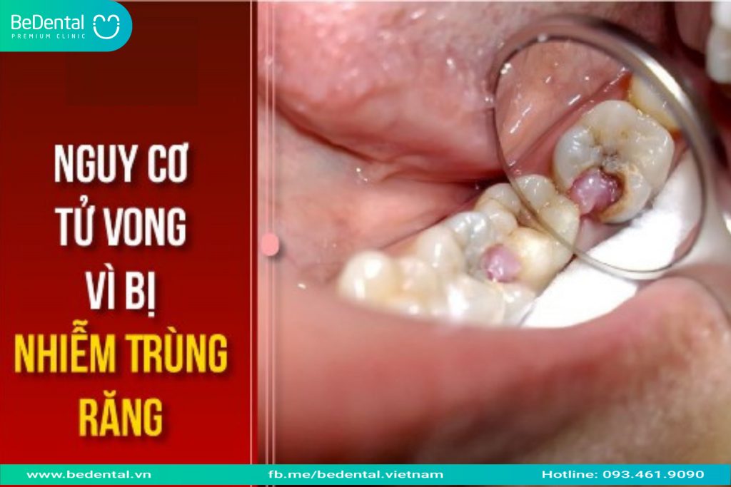 Lưu ý khi bị nhiễm trùng răng