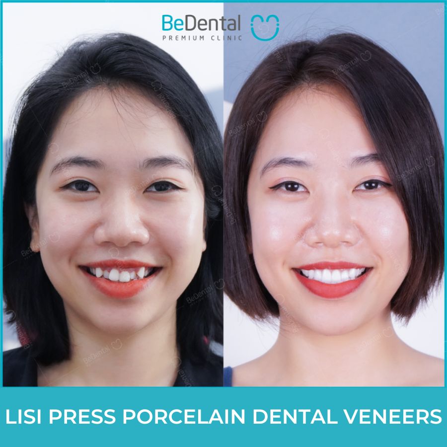 Before and after take Lisi Press veneers
