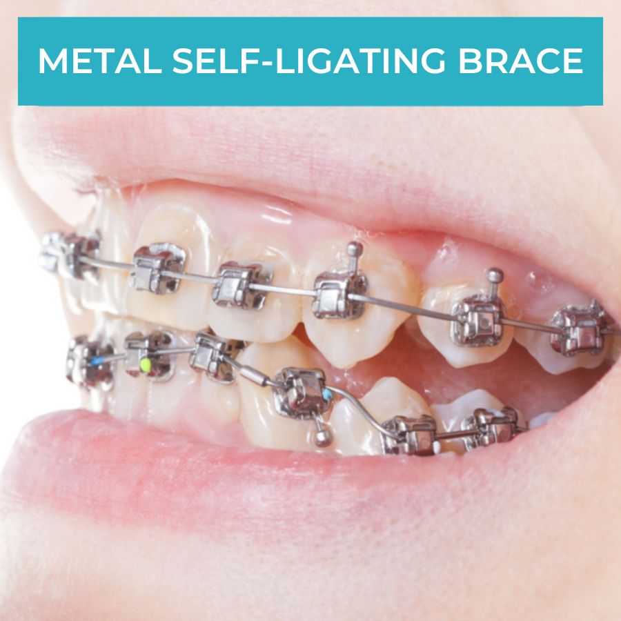 Metal self-ligating braces