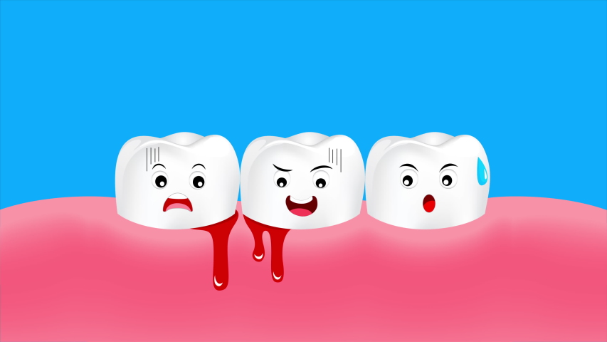Đánh răng bị chảy máu có thể là biểu hiện của viêm nướu răng, sâu răng, viêm nha chu và răng mọc lệch