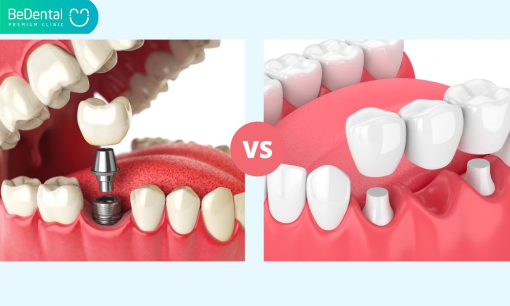 Dental Implant vs Dental Bridge