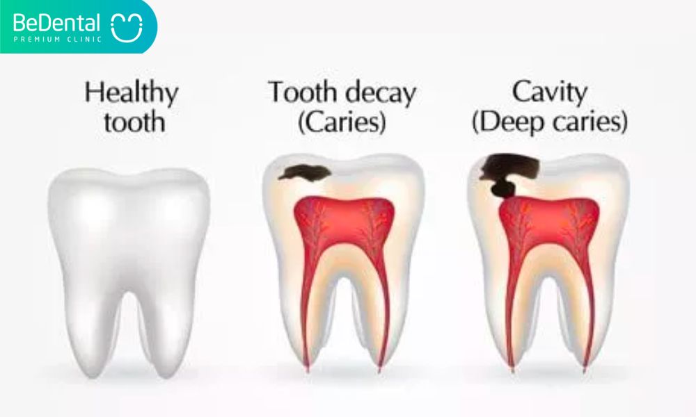 Tooth decay