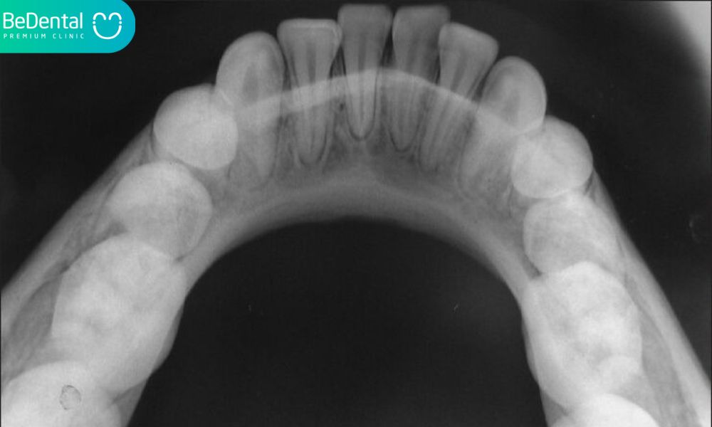 Occlusal