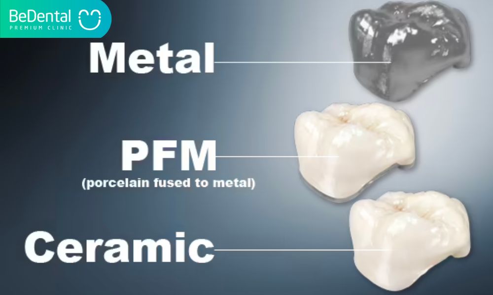 Types of dental crowns