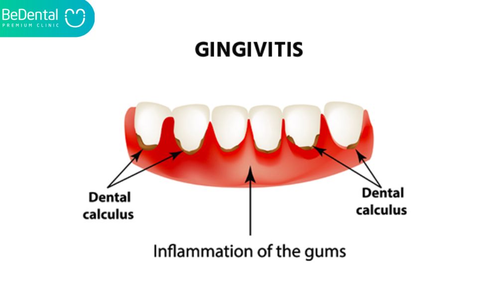 Gingivitis