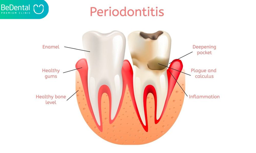 Periodontitis