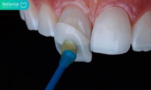 Composite Veneers