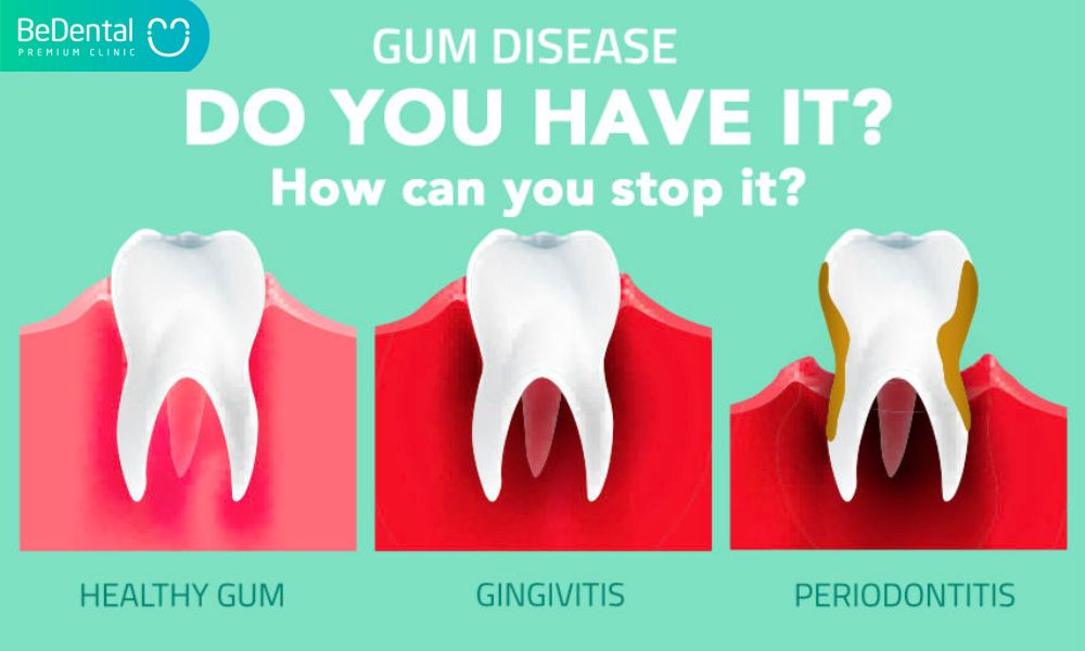 Dental diseases