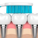 Dental implant care