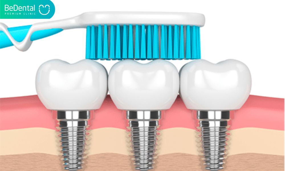 Dental implant care