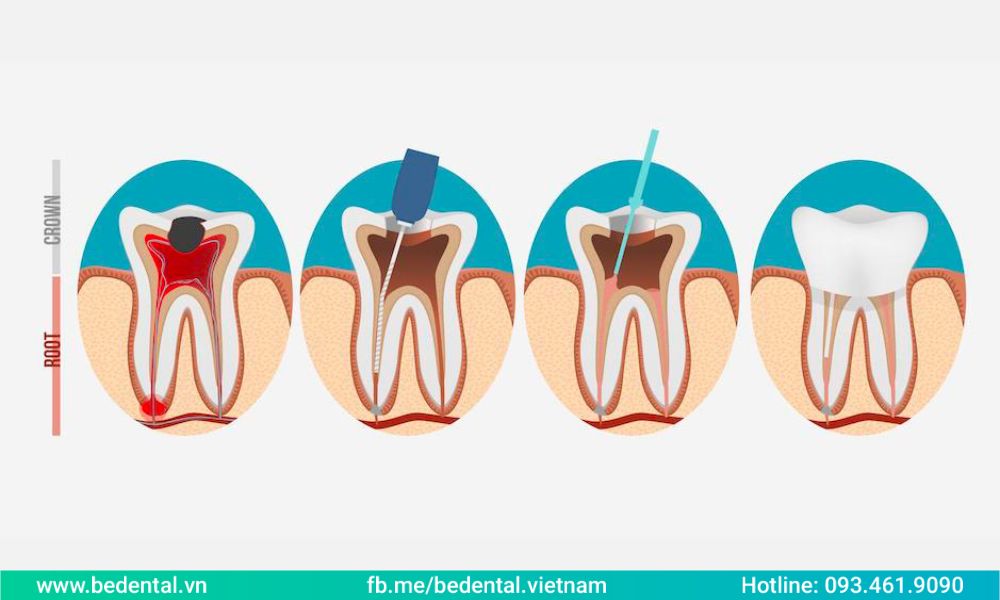 Root canal treatment process