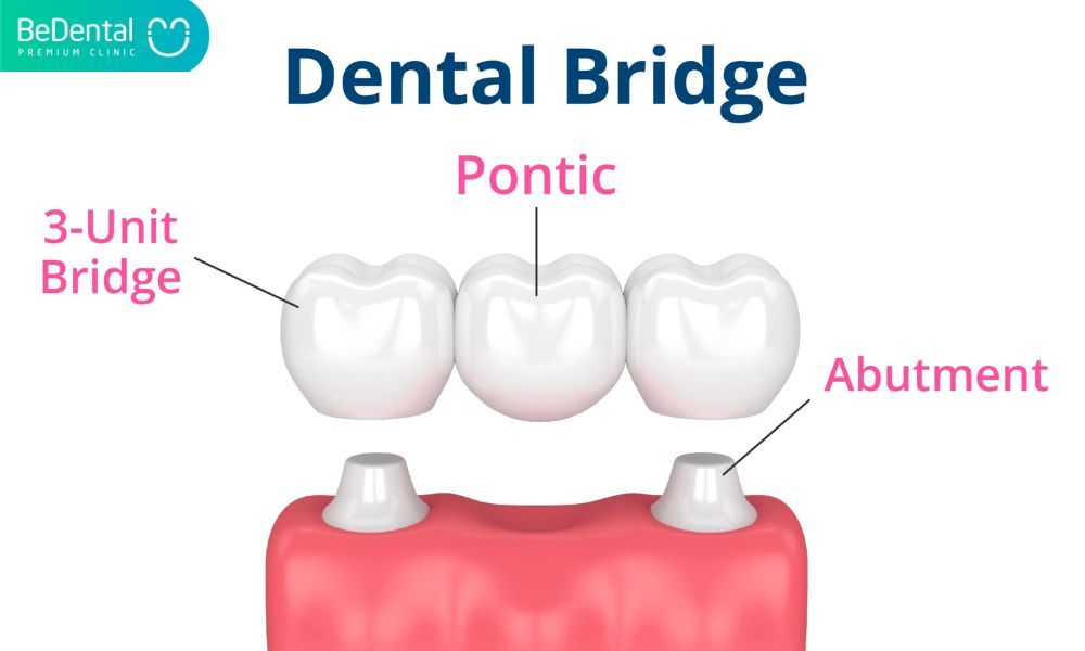 Dental Bridge Structure