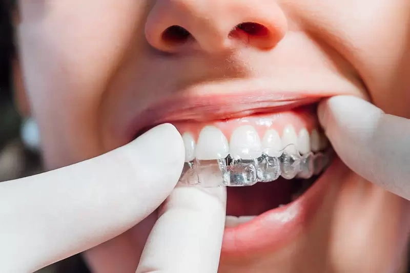 Trường hợp răng bị lệch và biến dạng nghiêm trọng bắt buộc phải niềng răng lại 