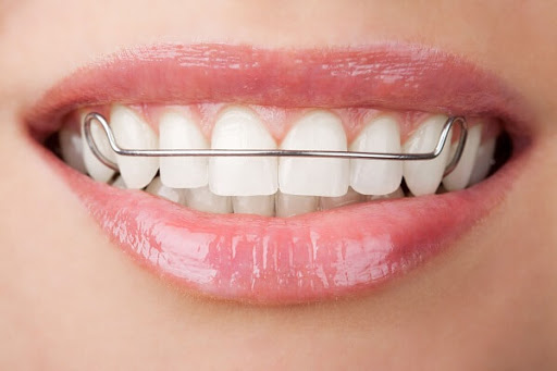 Đeo hàm duy trì không đủ thời gian là nguyên nhân hay gặp khiến răng di chuyển qua vị trí khác 