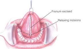 Phanh môi, má và lưỡi là các cơ liên kết giữa môi, má, lưỡi với phần mô bám trên răng hoặc với sàn miệng