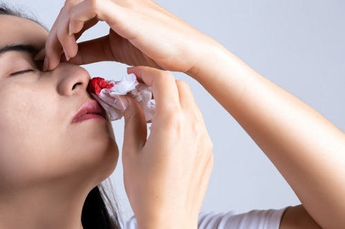 Chảy máu mũi là gì? Cách khắc phục chảy máu mũi!