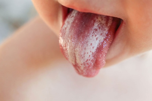 Bệnh nấm lưỡi hoặc nấm miệng là tình trạng lưỡi bị tưa do nấm Candida phát triển quá mức trong miệng