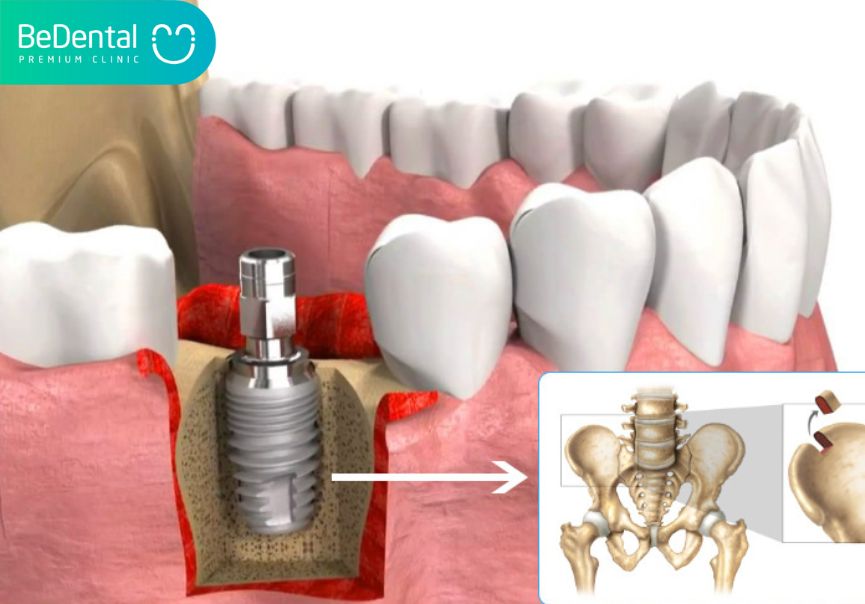 Có nhiều kỹ thuật ghép xương răng khác nhau để người dùng chọn lựa