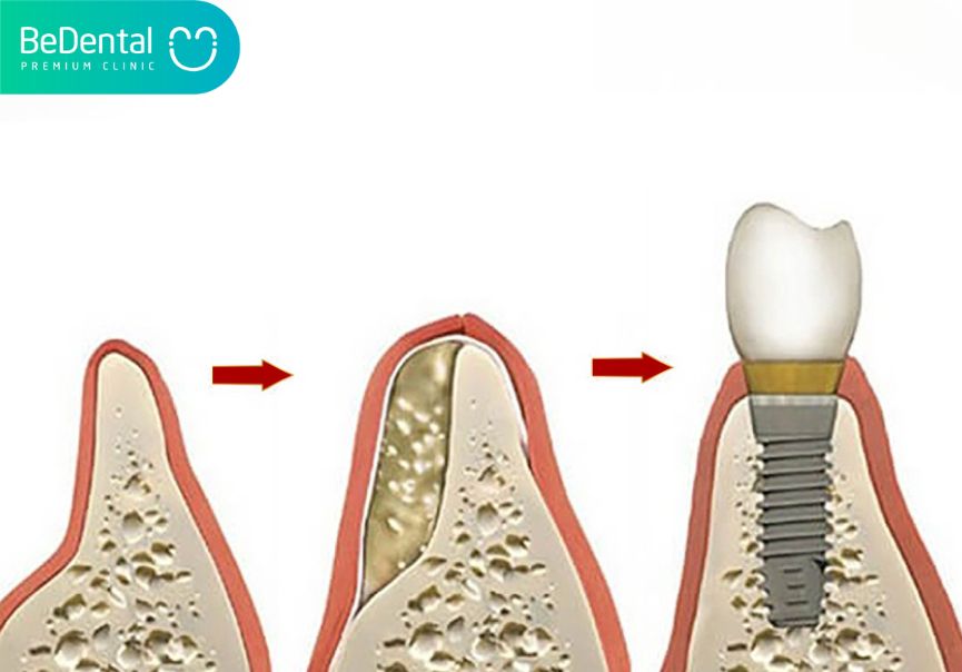 Bone grafts and implants