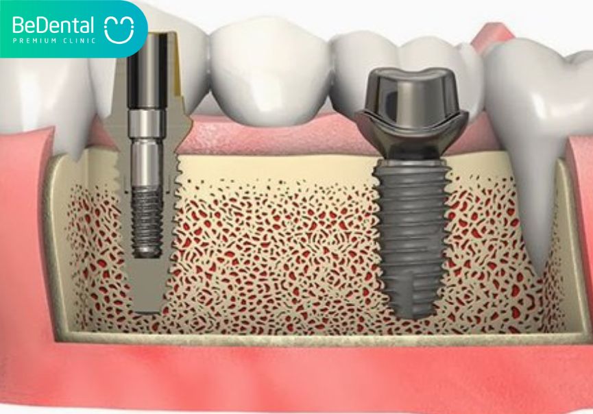 Nâng xoang hàm là thủ thuật được thực hiện với mục đích tăng thể tích xương, giúp cho xương hàm thỏa mãn được điều kiện về cả chiều cao, mật độ, thể tích để cấy ghép implant